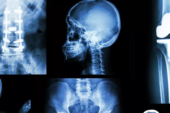 A collage of X-ray images shows a skull, the pelvis, the knee and the base of the spine with screws.