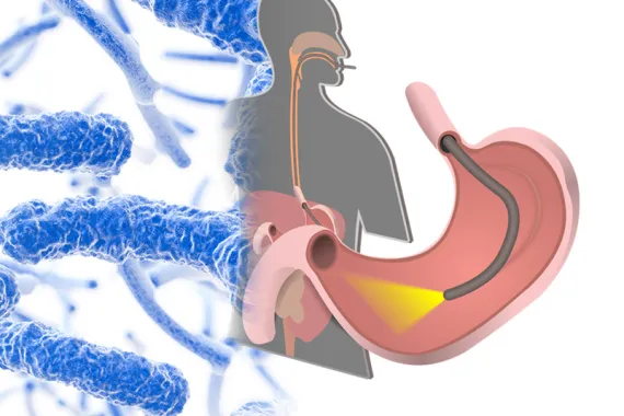 A depiction of how a duodenoscope works. The graphic shows the scope lighting the inside of the stomach