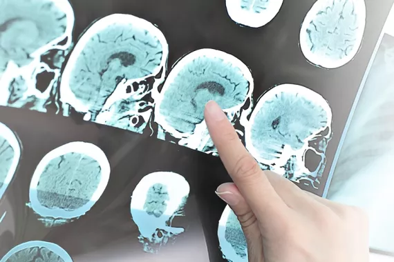 A finger points to one scan in a series of brain scans.
