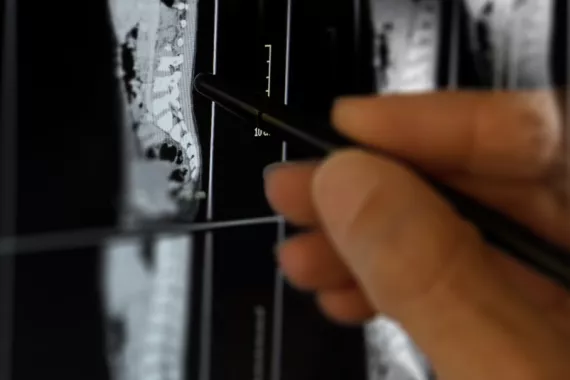 A hand uses a stylus to point to an X-ray of the sideview of a human midsection.
